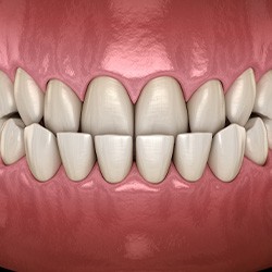 Illustration of an underbite