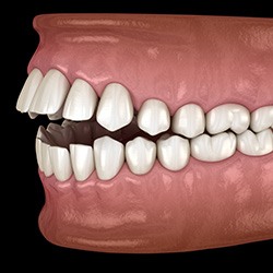 Illustration of an open bite