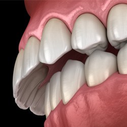 Digital illustration of overbite