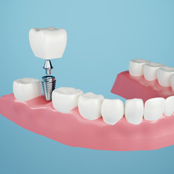a 3D illustration showing a single dental implant
