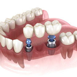 a 3D illustration showing a dental bridge with dental implants