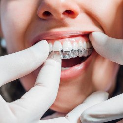 Dentist putting clear aligner on patient