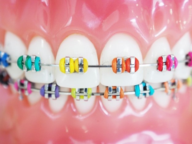 Rubber Bands for Whiter Teeth Sachse